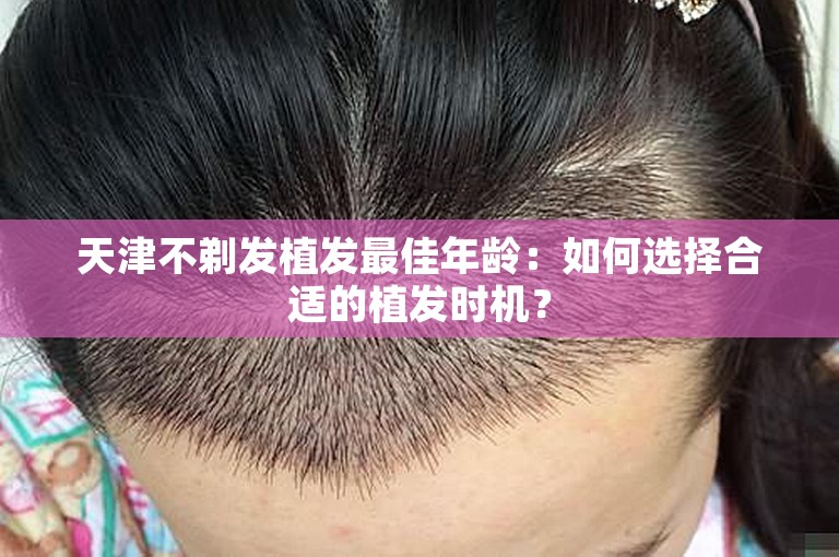 天津不剃发植发最佳年龄：如何选择合适的植发时机？