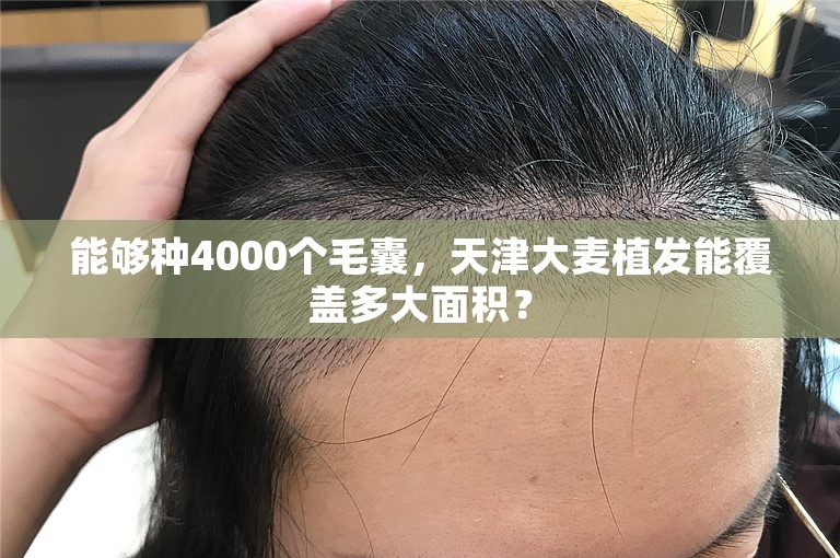 能够种4000个毛囊，天津大麦植发能覆盖多大面积？