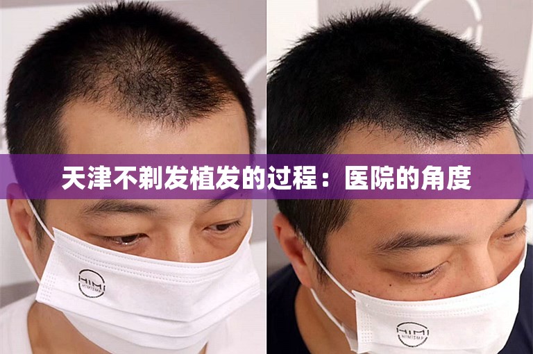 天津不剃发植发的过程：医院的角度