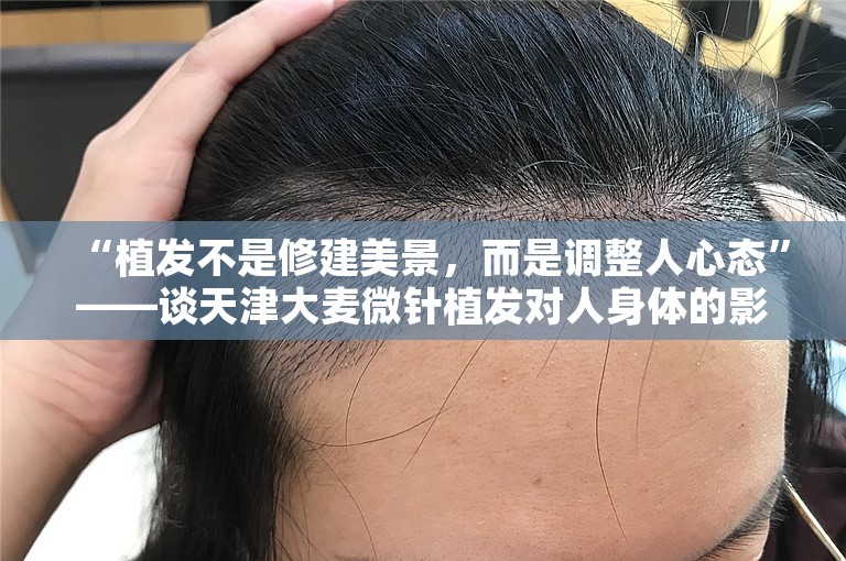 “植发不是修建美景，而是调整人心态”——谈天津大麦微针植发对人身体的影响