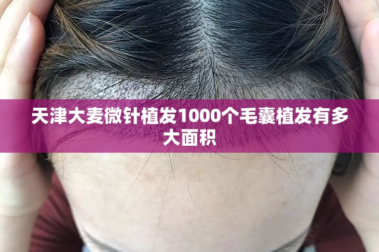 天津大麦微针植发1000个毛囊植发有多大面积