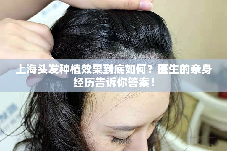 上海头发种植效果到底如何？医生的亲身经历告诉你答案！