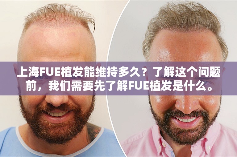 上海FUE植发能维持多久？了解这个问题前，我们需要先了解FUE植发是什么。