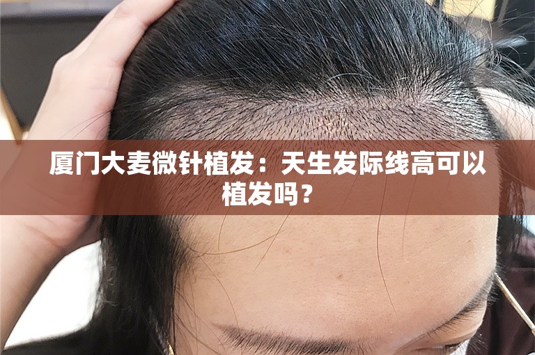 厦门大麦微针植发：天生发际线高可以植发吗？