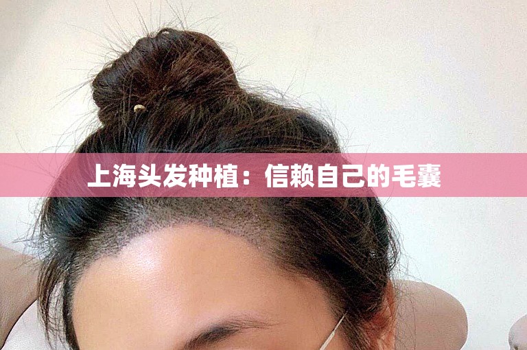 上海头发种植：信赖自己的毛囊