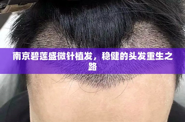 南京碧莲盛微针植发，稳健的头发重生之路