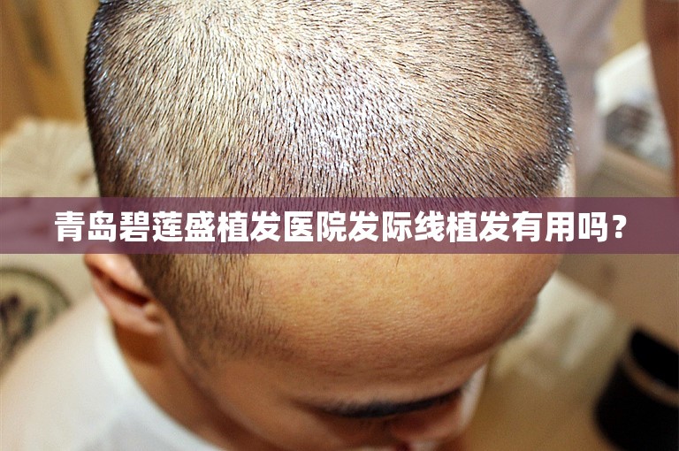 青岛碧莲盛植发医院发际线植发有用吗？