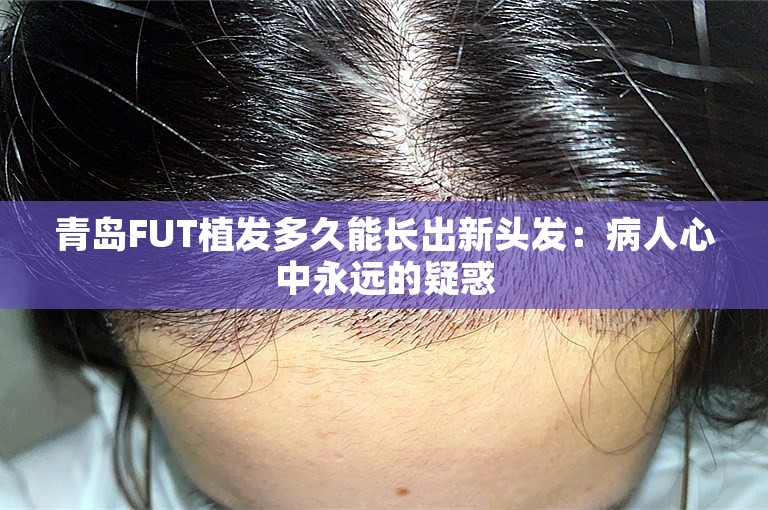 青岛FUT植发多久能长出新头发：病人心中永远的疑惑