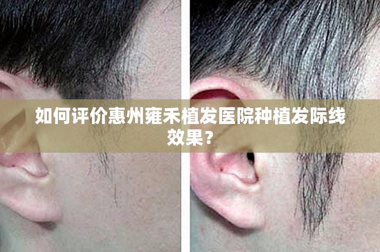 如何评价惠州雍禾植发医院种植发际线效果？