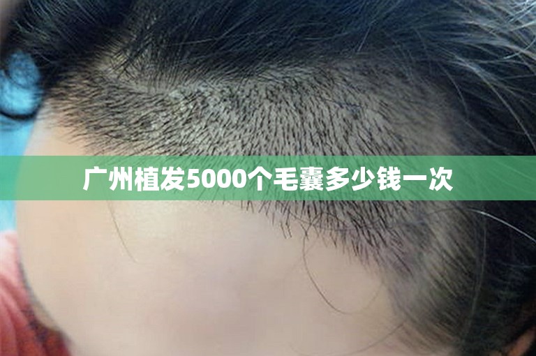 广州植发5000个毛囊多少钱一次