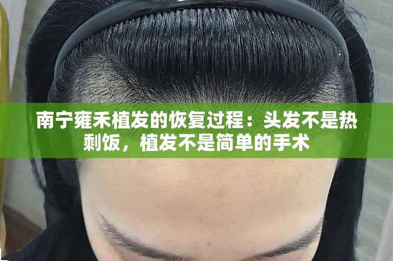 南宁雍禾植发的恢复过程：头发不是热剩饭，植发不是简单的手术