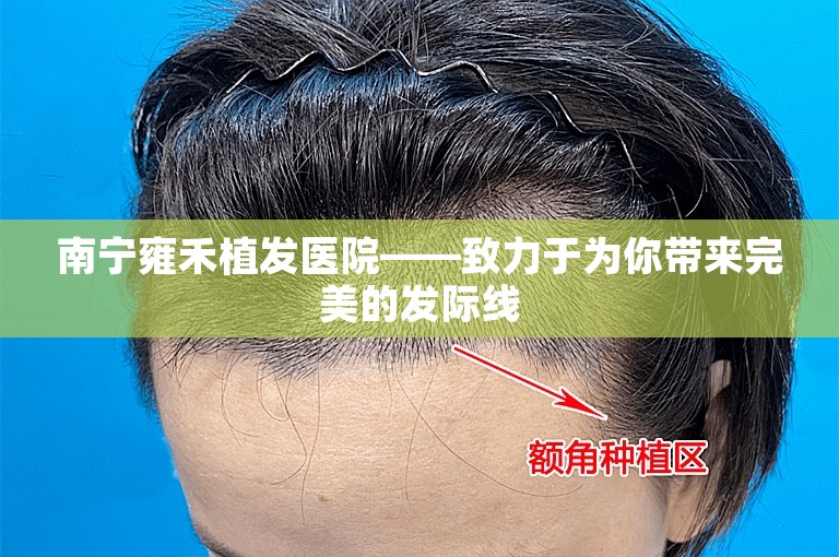 南宁雍禾植发医院——致力于为你带来完美的发际线