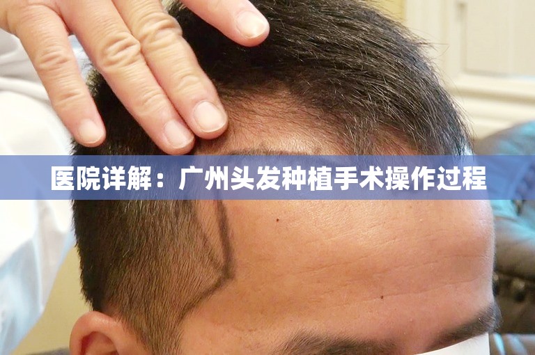 医院详解：广州头发种植手术操作过程