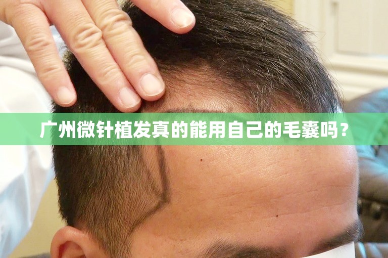 广州微针植发真的能用自己的毛囊吗？