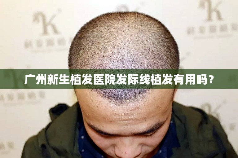 广州新生植发医院发际线植发有用吗？