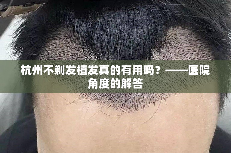 杭州不剃发植发真的有用吗？——医院角度的解答