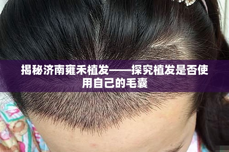 揭秘济南雍禾植发——探究植发是否使用自己的毛囊