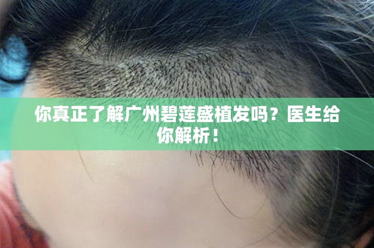 你真正了解广州碧莲盛植发吗？医生给你解析！