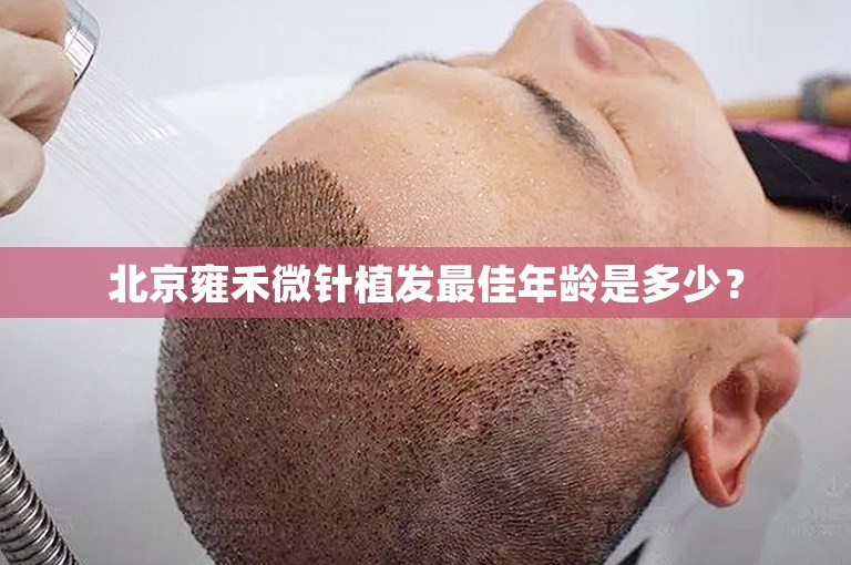 北京雍禾微针植发最佳年龄是多少？