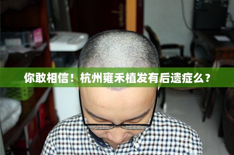 你敢相信！杭州雍禾植发有后遗症么？