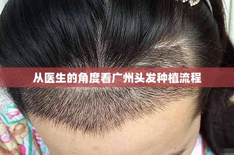 从医生的角度看广州头发种植流程