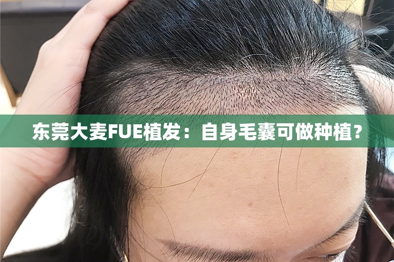 东莞大麦FUE植发：自身毛囊可做种植？