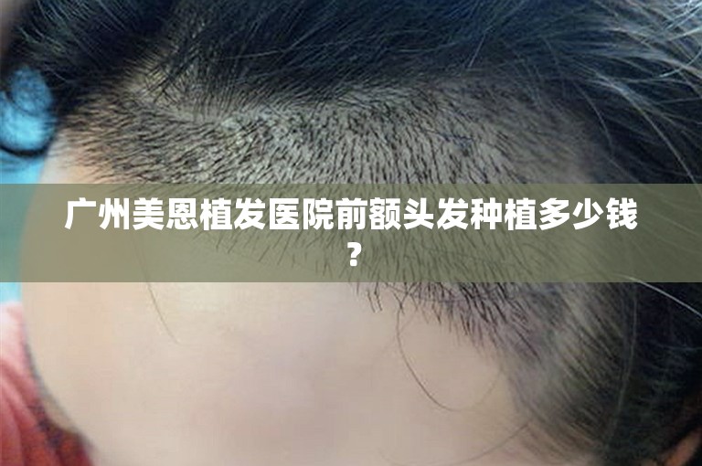 广州美恩植发医院前额头发种植多少钱？
