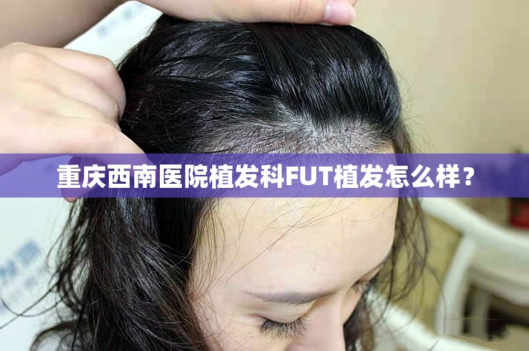 重庆西南医院植发科FUT植发怎么样？