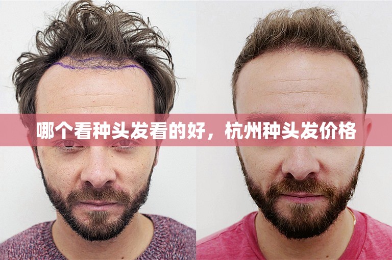 哪个看种头发看的好，杭州种头发价格