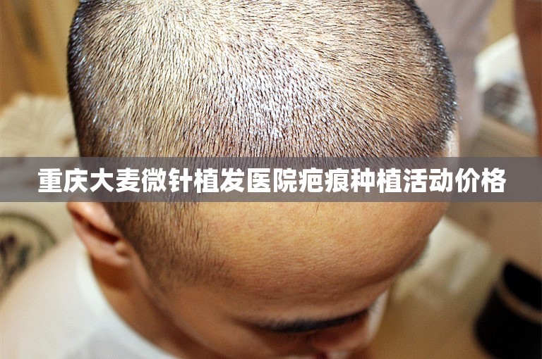 重庆大麦微针植发医院疤痕种植活动价格