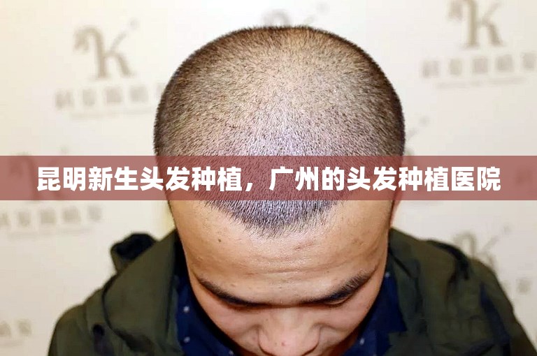 昆明新生头发种植，广州的头发种植医院