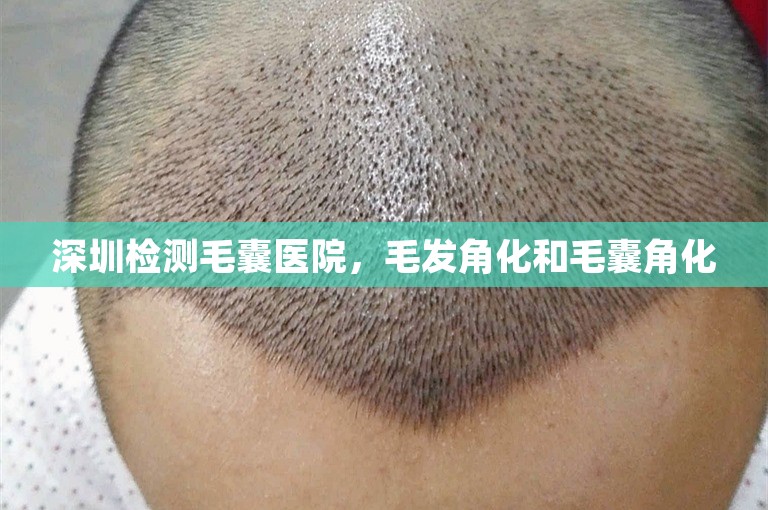 深圳检测毛囊医院，毛发角化和毛囊角化
