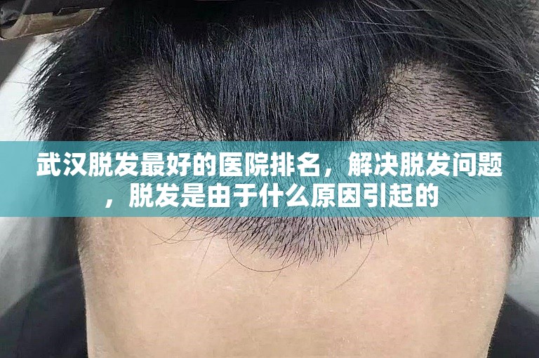 武汉脱发最好的医院排名，解决脱发问题，脱发是由于什么原因引起的