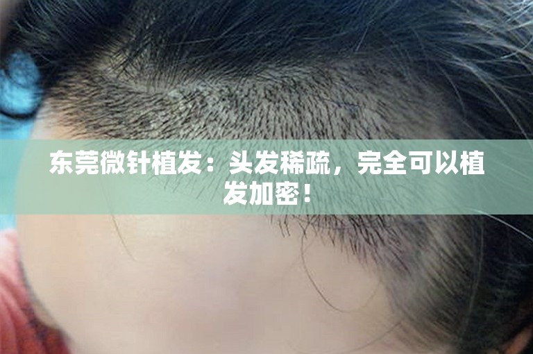 东莞微针植发：头发稀疏，完全可以植发加密！