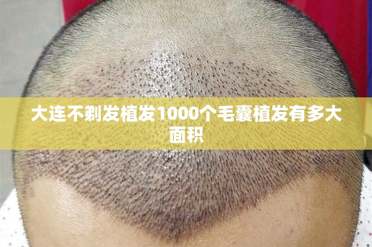 大连不剃发植发1000个毛囊植发有多大面积