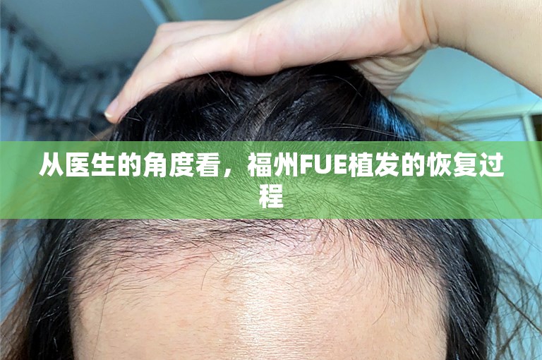 从医生的角度看，福州FUE植发的恢复过程