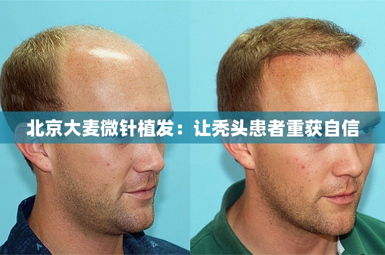 北京大麦微针植发：让秃头患者重获自信