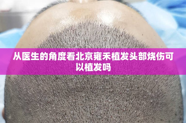 从医生的角度看北京雍禾植发头部烧伤可以植发吗