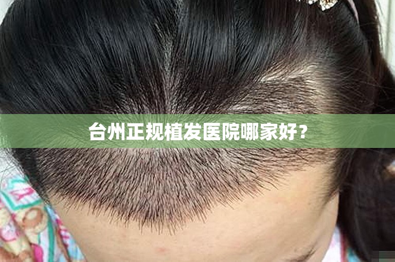 台州正规植发医院哪家好？