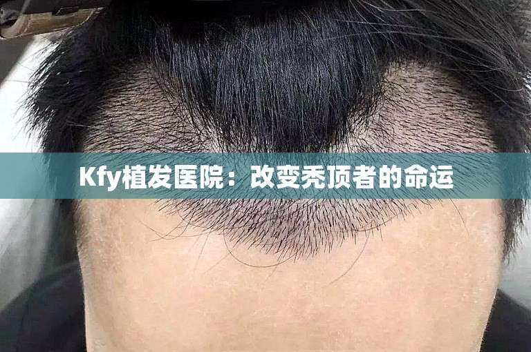Kfy植发医院：改变秃顶者的命运