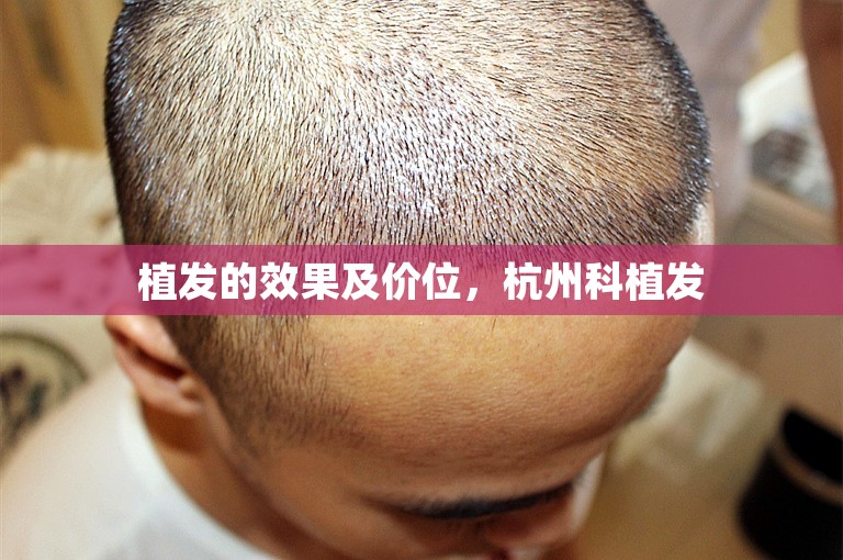 植发的效果及价位，杭州科植发