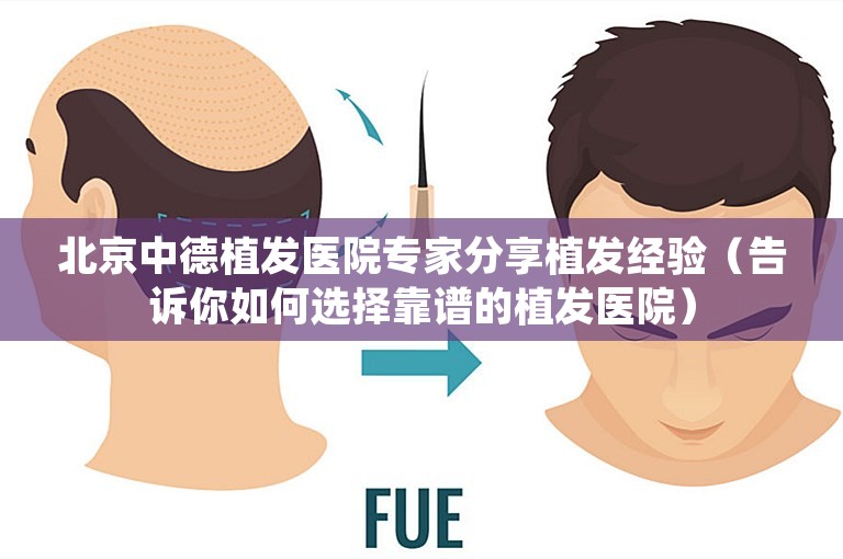北京中德植发医院专家分享植发经验（告诉你如何选择靠谱的植发医院）