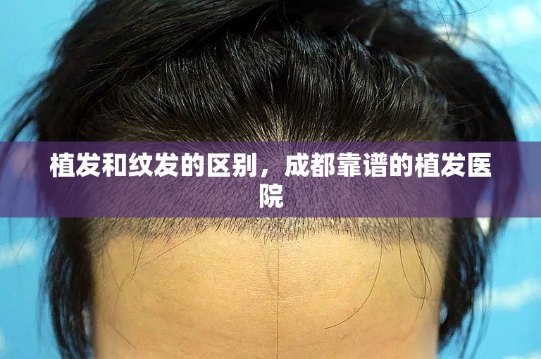 植发和纹发的区别，成都靠谱的植发医院