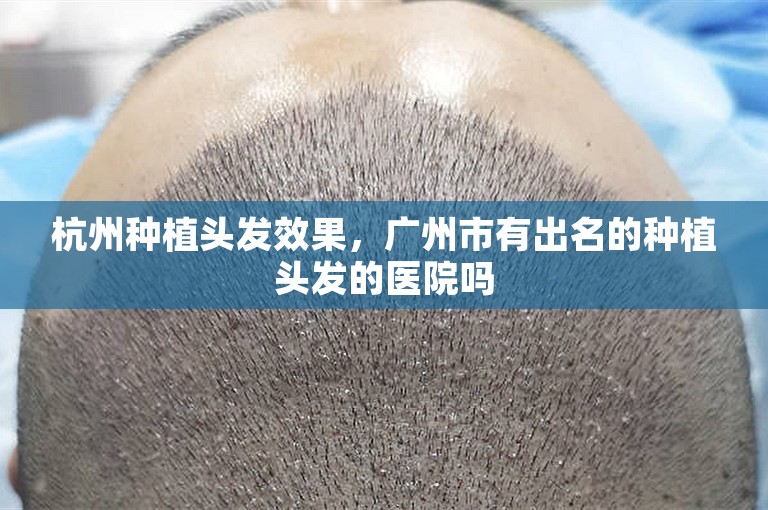 杭州种植头发效果，广州市有出名的种植头发的医院吗