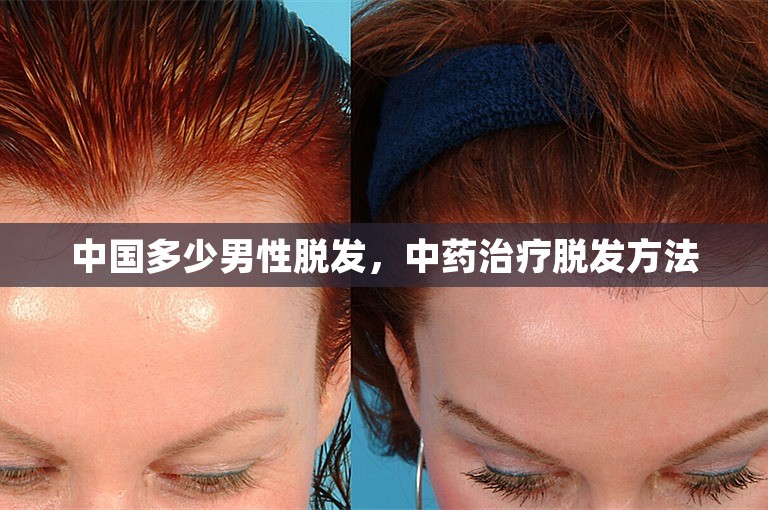 中国多少男性脱发，中药治疗脱发方法
