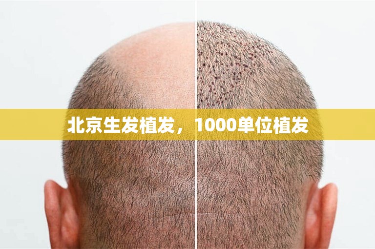 北京生发植发，1000单位植发