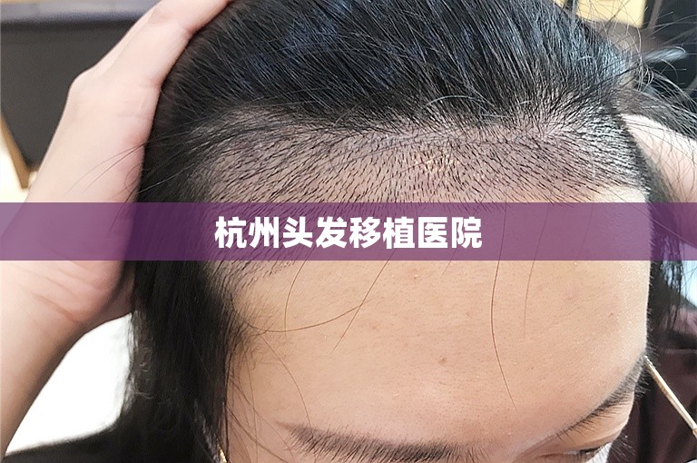 杭州头发移植医院
