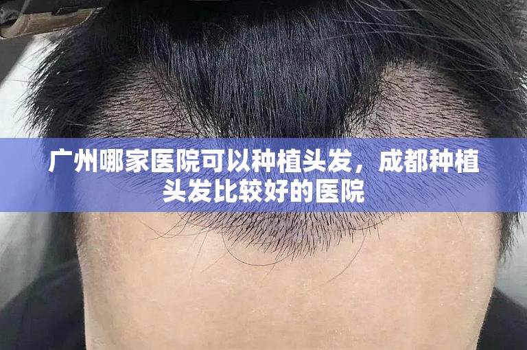 广州哪家医院可以种植头发，成都种植头发比较好的医院
