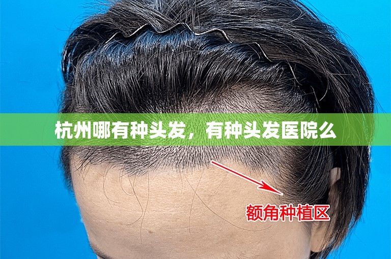 杭州哪有种头发，有种头发医院么