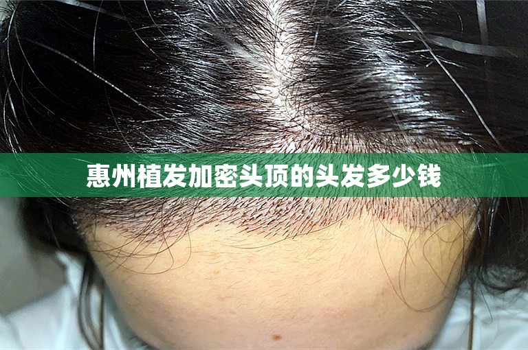 惠州植发加密头顶的头发多少钱